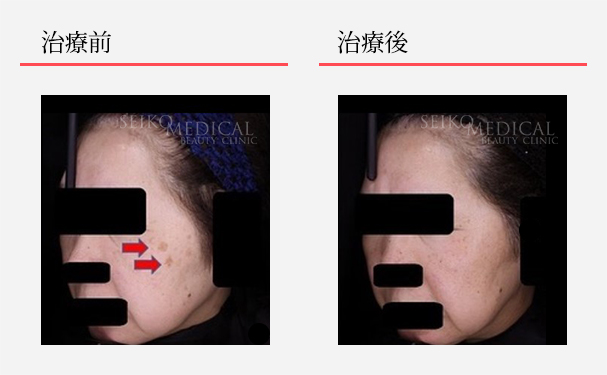 ゼオスキン症例写真23